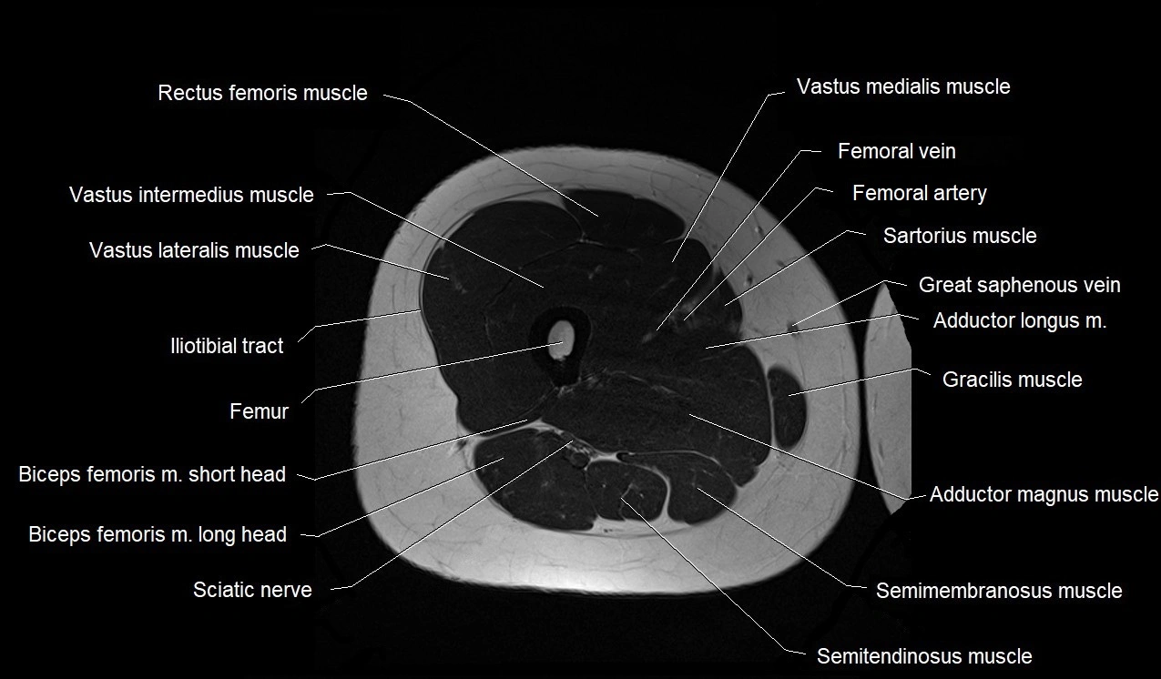 MRI thigh cross sectional anatomy image 30.webp